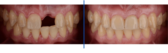 Before / After of a Single Dental Implant